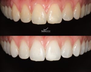 antes y despues tratamiento de blanqueamiento dental - santos dental Murcia 10