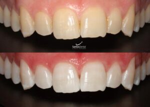 antes y despues tratamiento de blanqueamiento dental - santos dental Murcia 11