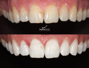 antes y despues tratamiento de blanqueamiento dental - santos dental Murcia 12