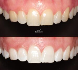 antes y despues tratamiento de blanqueamiento dental - santos dental Murcia 2