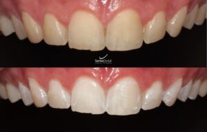 antes y despues tratamiento de blanqueamiento dental - santos dental Murcia 3