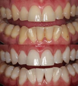 antes y despues tratamiento de blanqueamiento dental - santos dental Murcia 4