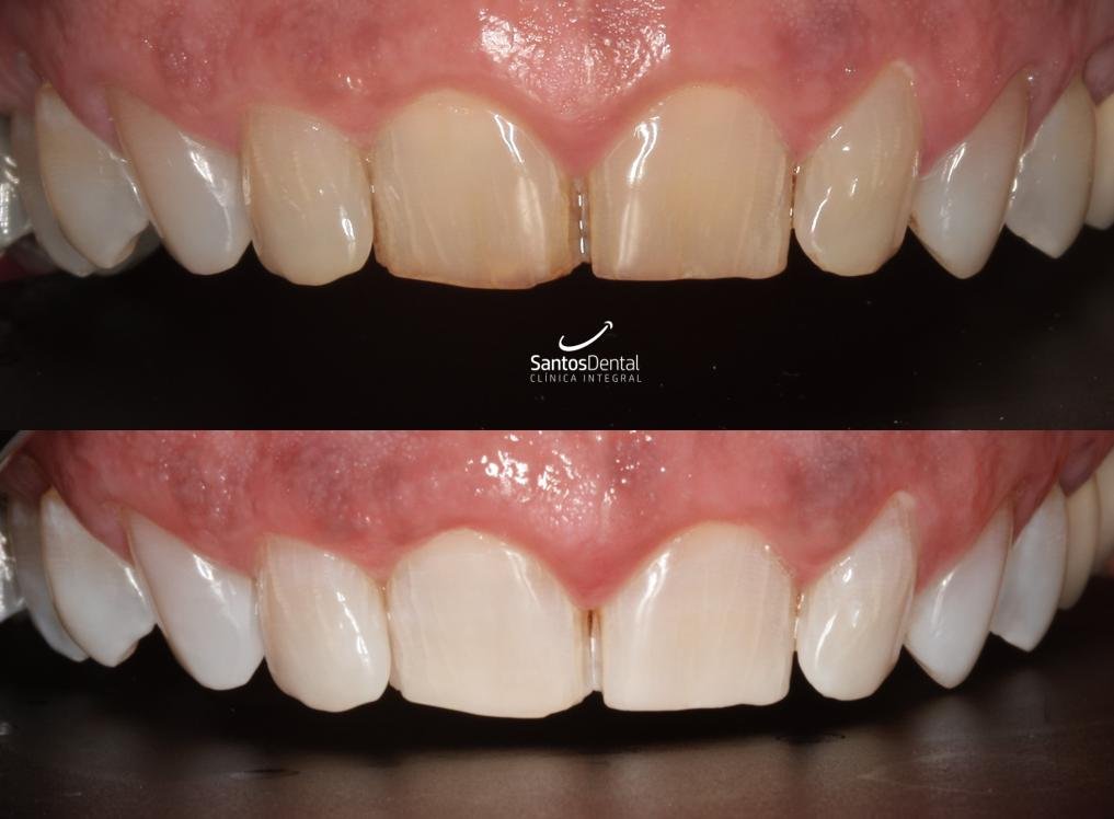 Antes y después de un tratamiento de blanqueamiento dental en Santos Dental Murcia, caso 5