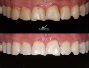 antes y despues tratamiento de blanqueamiento dental - santos dental Murcia 6