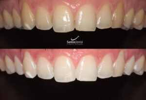 antes y despues tratamiento de blanqueamiento dental - santos dental Murcia 7