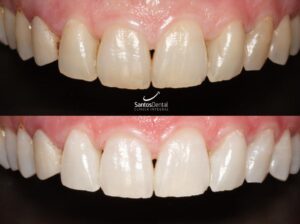 antes y despues tratamiento de blanqueamiento dental - santos dental Murcia 8