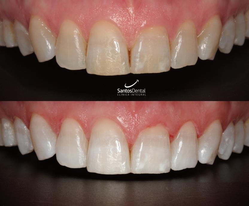 Antes y después de un tratamiento de blanqueamiento dental en Santos Dental Murcia, caso 9