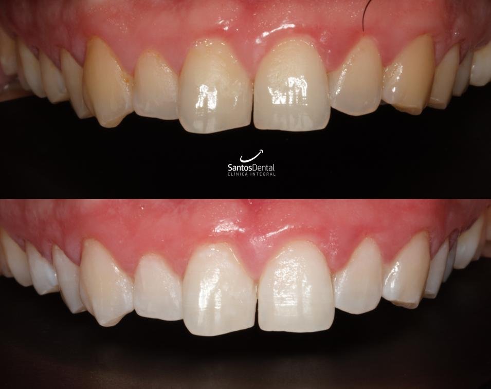 Antes y después de un tratamiento de blanqueamiento dental en Santos Dental Murcia, caso 1